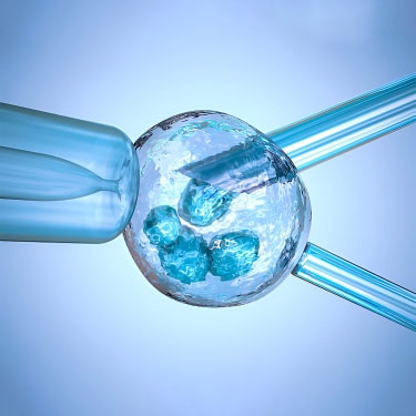 Preimplantation Genetic Screening